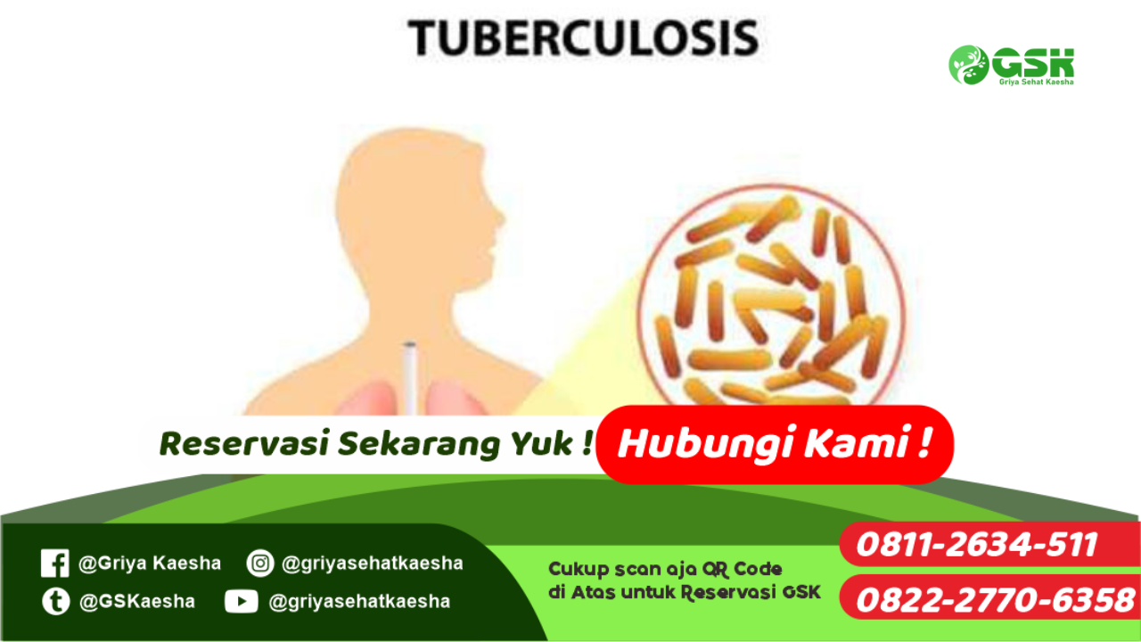 terapi-penyakit-tuberkulosis-tanpa-obat-dengan-metode-terapi-paz-al-kasaw