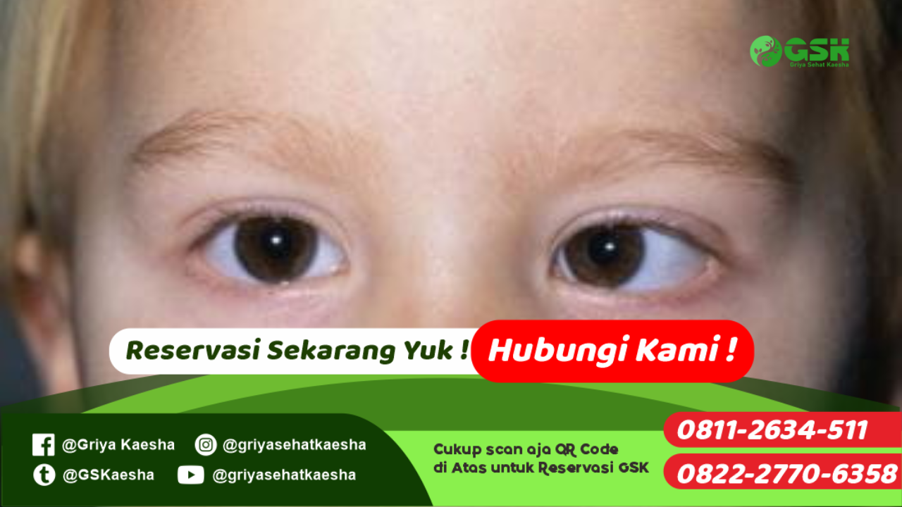 terapi-penyakit-strabismus-tanpa-obat-dengan-metode-terapi-paz-al-kasaw