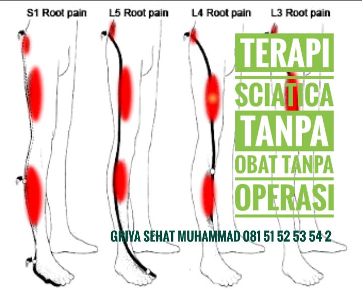 sciatica-di-gergaji-..loh...kok-enak-ya-rasa-nya