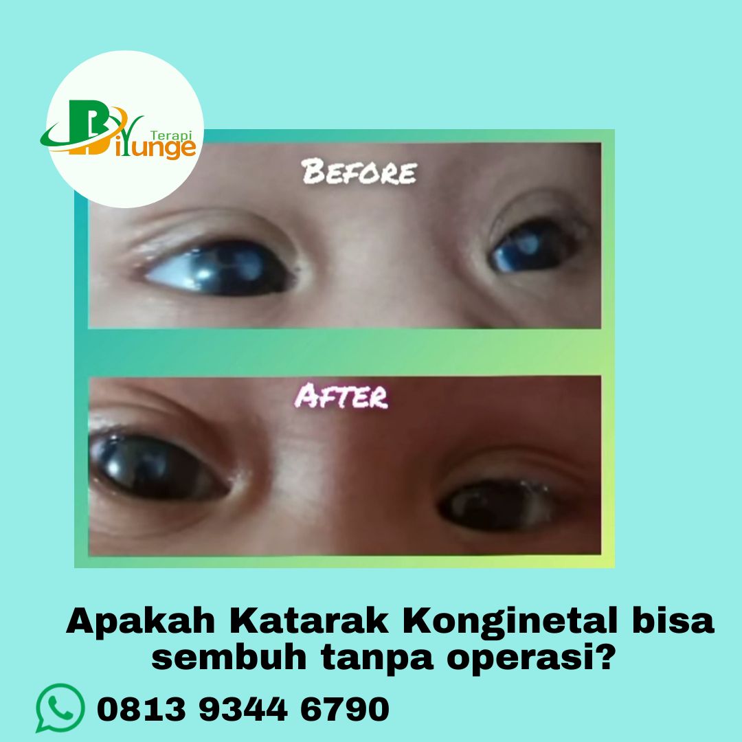 membantu-mengikhtiarkan-katarak-kongenital-tanpa-operasi
