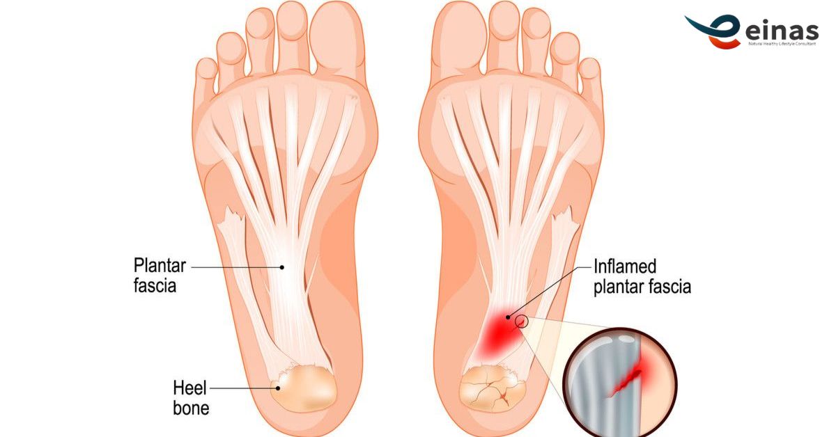 kaki-sakit-bagian-tumit -sembuh-tanpa-operasi-dengan-terapi-paz