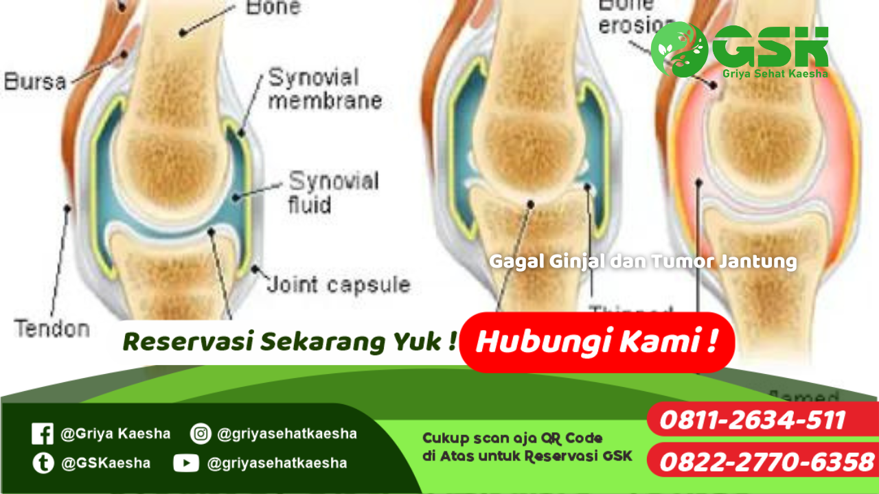 terapi-penyakit-lutut-sakit-tanpa-obat-dengan-metode-terapi-paz-al-kasaw