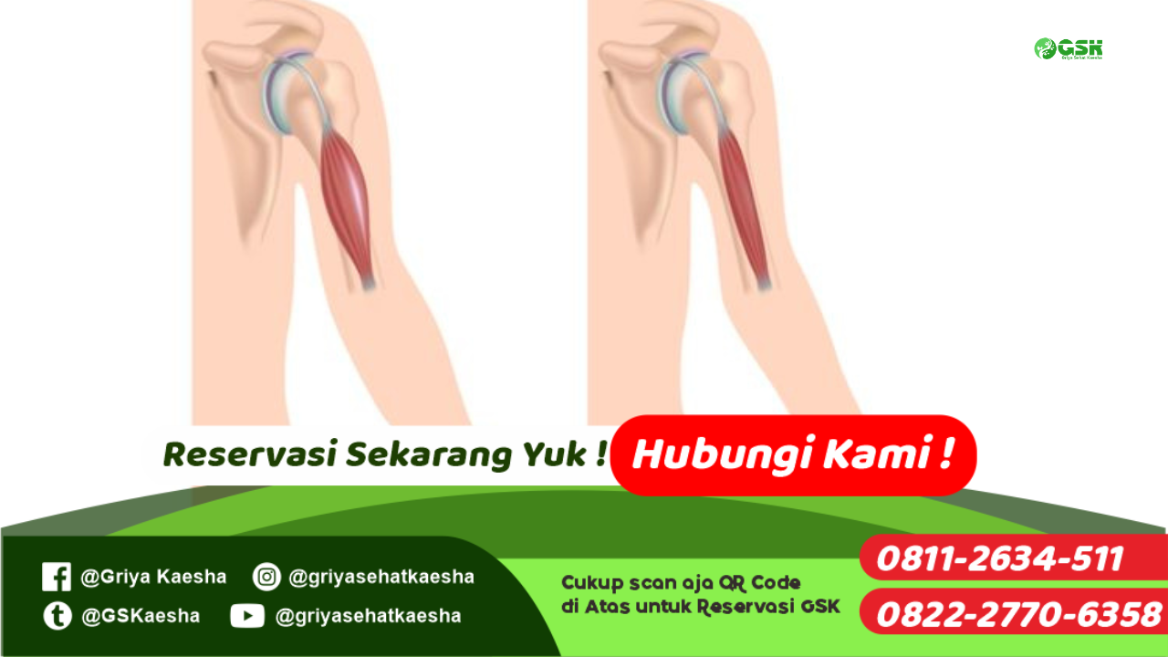 terapi-penyakit-pemendekkan-otot-tanpa-obat-dengan-metode-terapi-paz-al-kasaw