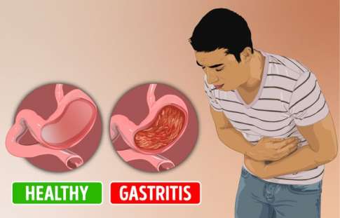 obat-sakit-gerd-alami-metode-paz-al-kasaw