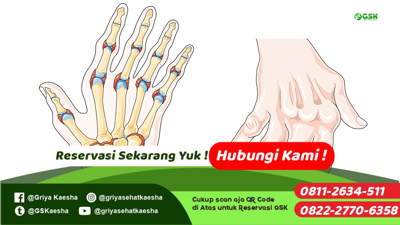 terapi-rheumatoid-tanpa-obat-dengan-metode-terapi-paz-al-kasaw