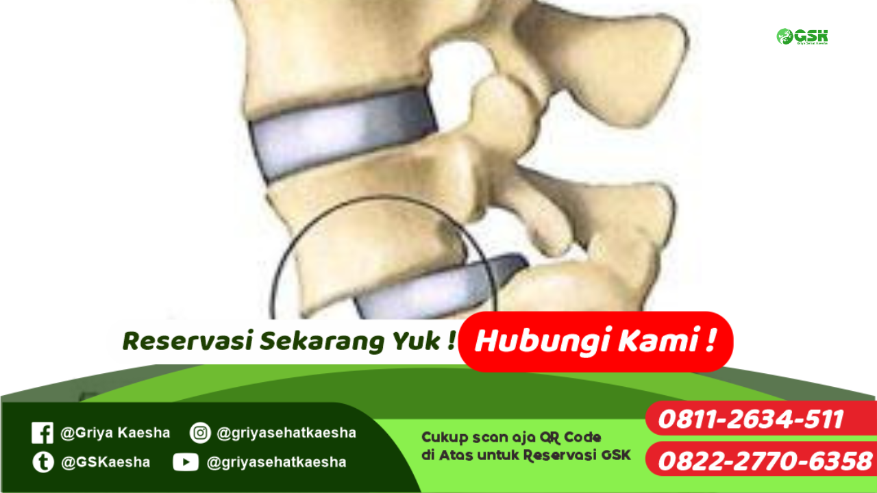 terapi-penyakit-penyempitan-l5s1-tanpa-obat-dengan-metode-terapi-paz-al-kasaw