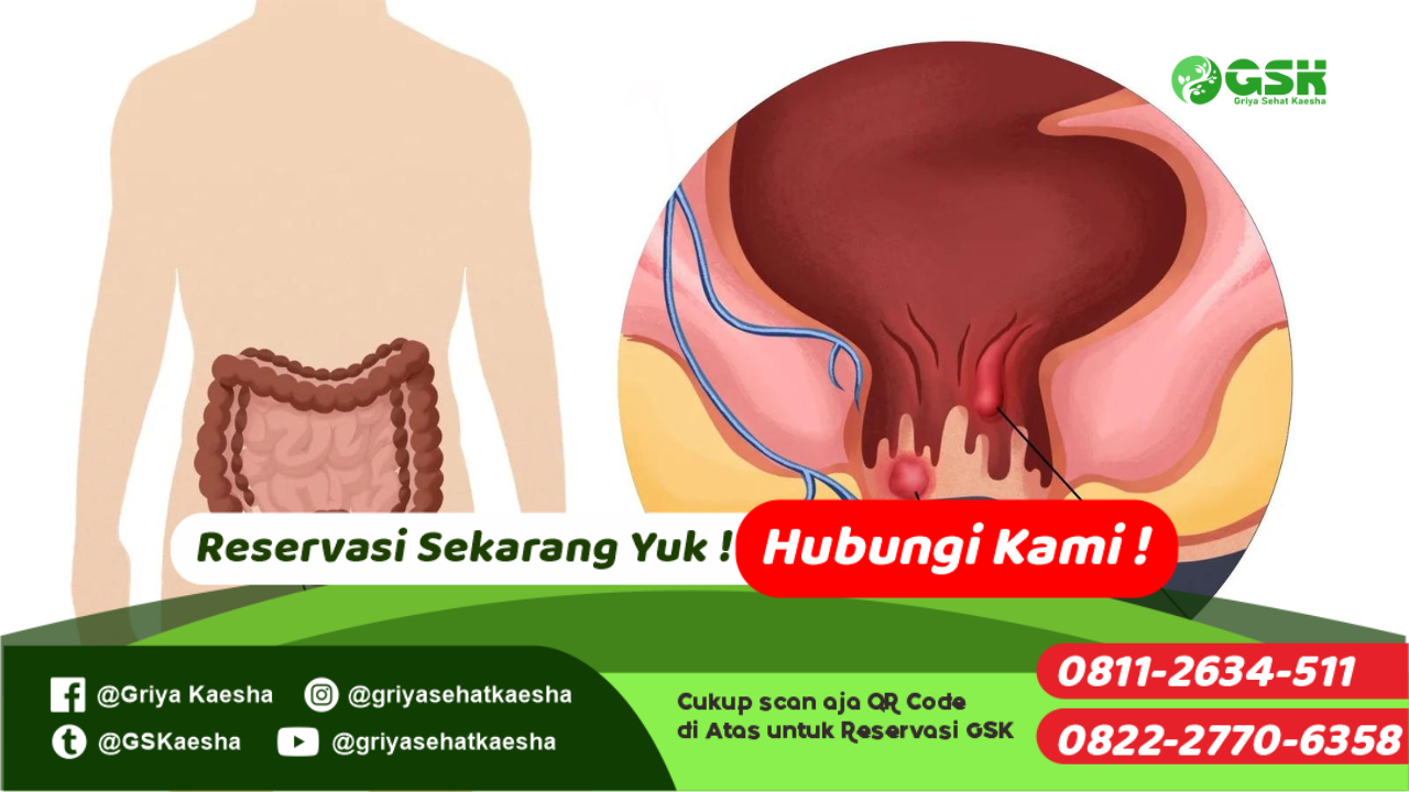 terapi-penyakit-hemoroid-tanpa-obat-dengan-metode-terapi-paz-al-kasaw