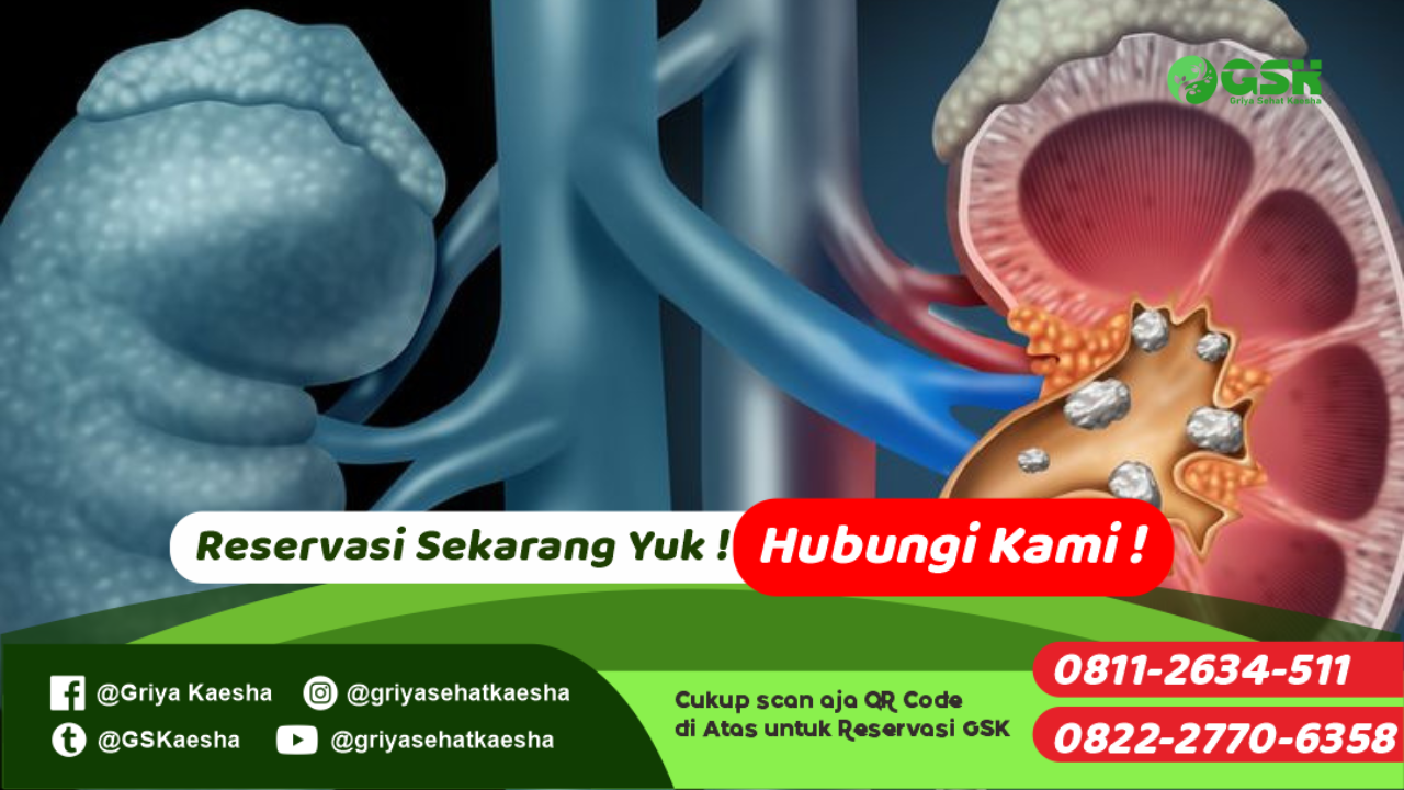 terapi-penyakit-batu-ginjal-tanpa-obat-dengan-metode-terapi-paz-al-kasaw