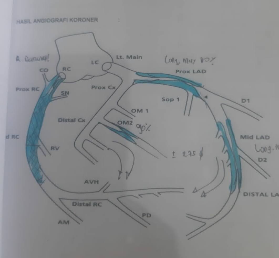 pengobatan-jantung-korroner