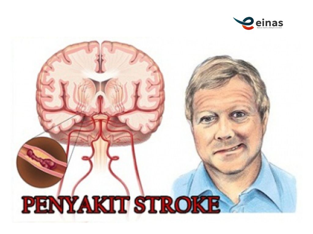 perjalanan-ikhtiar-bapak-tugiyo-menghadapi-stroke-bersama-terapi-paz