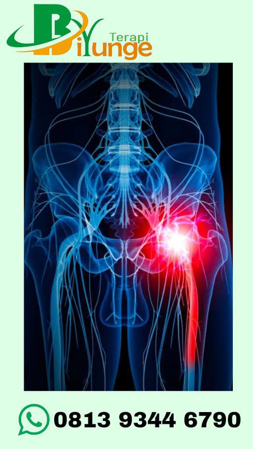 cara-aman-dan-nyaman-mengatasi-sciatica